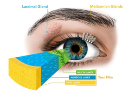 Meibomian Gland Dysfunction graphic