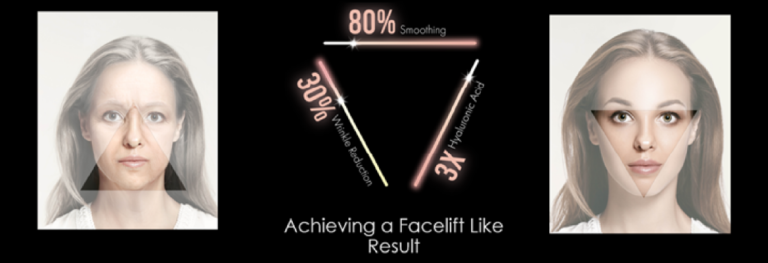 Achieve a facelift like result without surgery with RF microneedling and TriLift