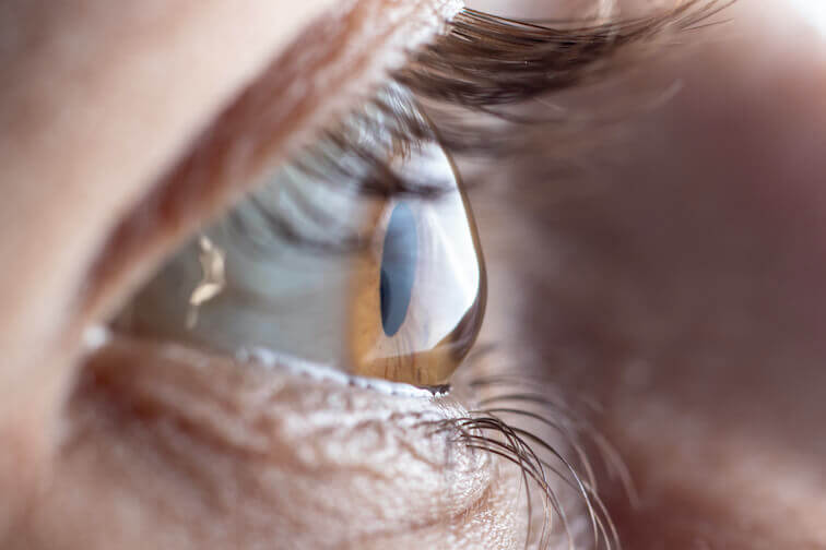 Closeup of an Eye With Keratoconus