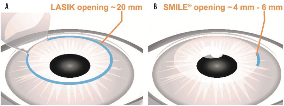 SMILE flapless LASIK incision